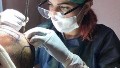 صورة توضيحية - زراعة الشعر بدون حلاقة اً في مركز Estepera