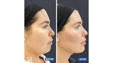 صورة توضيحية - دكتور التجميل و الترميم رامي عبادي يسلط الضوء على استخدام الفيلر للجزء السفلي من الوجه