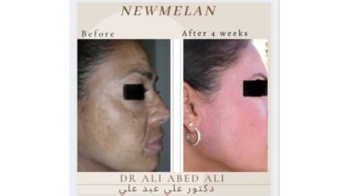صورة توضيحية - دكتور التجميل ali abedali يتحدث عن تقنية newmelan pigmentation